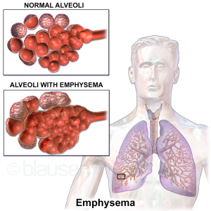 Diagram of alveoli with emphysema