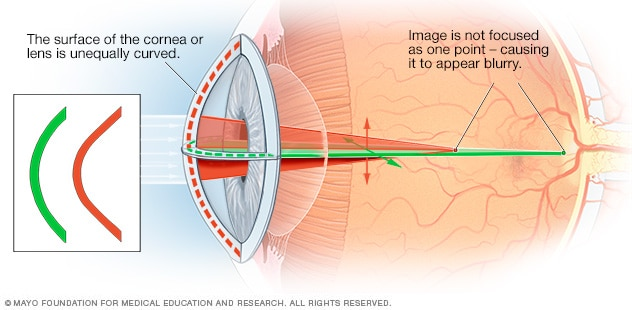 Astigmatism Astigmatism Astigmatism is a type of refractive error caused when either the cornea or the lens has mismatched curves. This makes vision blurry because there are two image points.