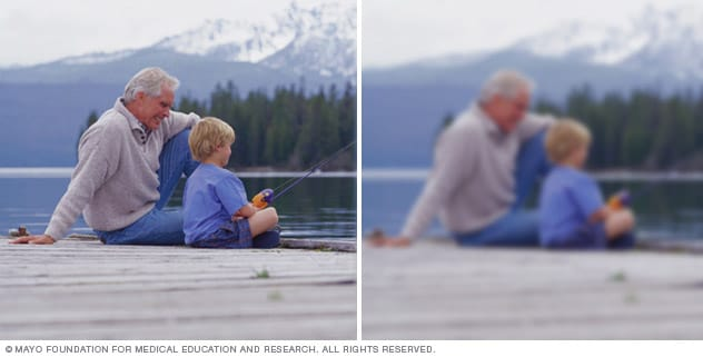 How a cataract affects your vision How a cataract affects your vision Clear vision, like on the left, becomes blurred as a cataract forms, like on the right.