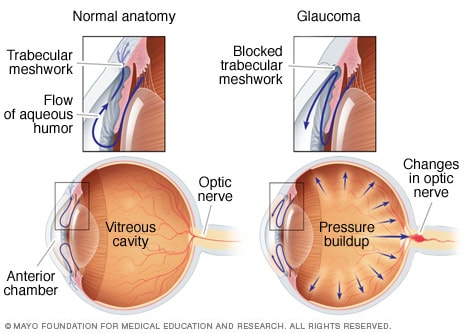 Open-angle glaucoma Open-angle glaucoma Usually, fluid called aqueous humor flows freely through the anterior chamber in the eye and exits through the drainage system, known as the trabecular meshwork. If that system is blocked or isn't functioning well, the pressure inside the eye builds. This pressure can damage the optic nerve. With the most common type of glaucoma, this results in gradual vision loss.