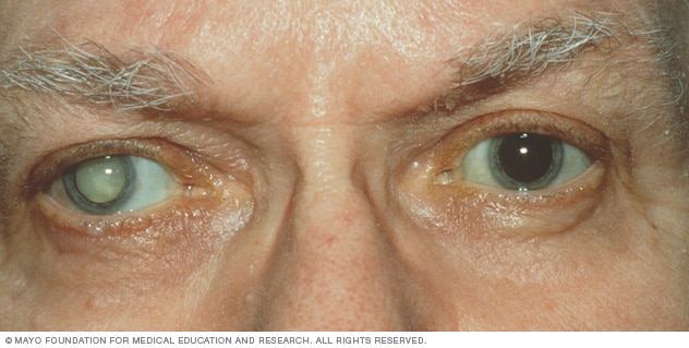 What a cataract looks like What a cataract looks like A cataract occurs when the lens of your eye becomes cloudy. Eventually, a cataract can become like the one shown in this person's right eye.